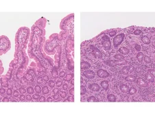 Coeliac Biopsies Land 2088x1175 1 869x500