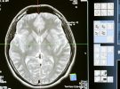 China permite a un paciente controlar dispositivos con solo pensar en un avance histórico en neurotecnología
